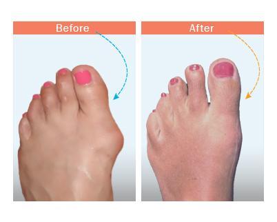 BodyWellness™-Comfy Orthotic Bunion Correcting Sandals-200001002-InspiredBeing