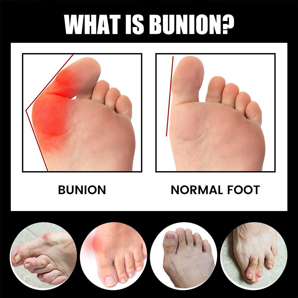 Anti-Bunions Outdoor Health Socks For Pain And Stiffness Relief